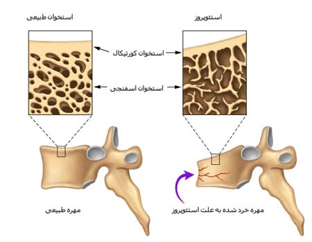 بیماری استئوپورز