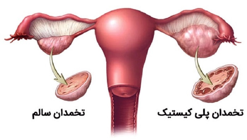 کاهش وزن در سندرم تخمدان پلی کیستیک 